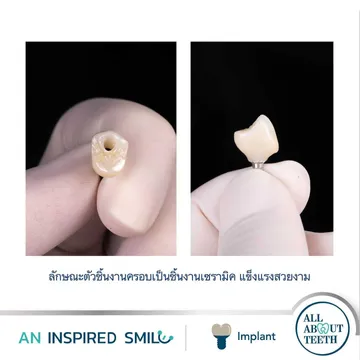 LINEALBUMAnInspiredSmileDentalImplant2303146