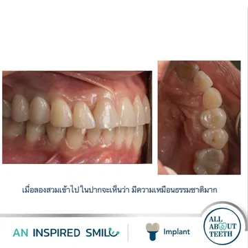 LINEALBUMAnInspiredSmileDentalImplant2303147