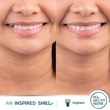 LINEALBUMAnInspiredSmileDentalImplant2303148