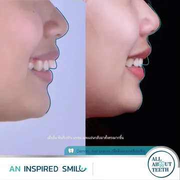 LINEALBUMAninspiredsmileDamon(fastbraces)23031414