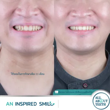 LINEALBUMAninspiredsmileDamon(fastbraces)23031416