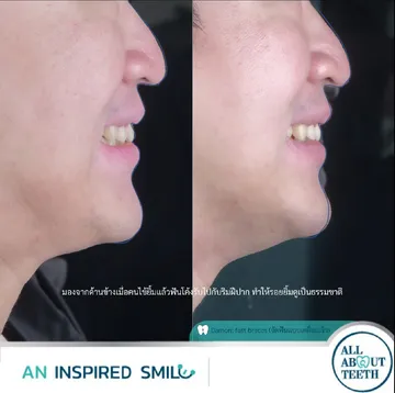 LINEALBUMAninspiredsmileDamon(fastbraces)23031417