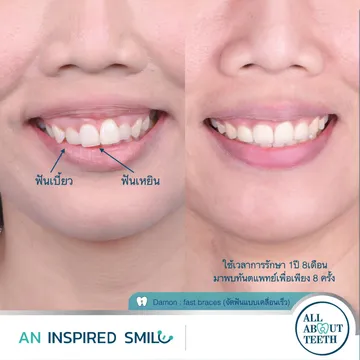 LINEALBUMAninspiredsmileDamon(fastbraces)2303143
