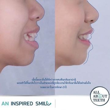 รีวิว-จัดฟันปกติ6