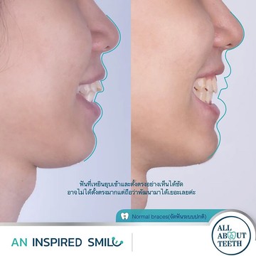 รีวิว-จัดฟันปกติ7