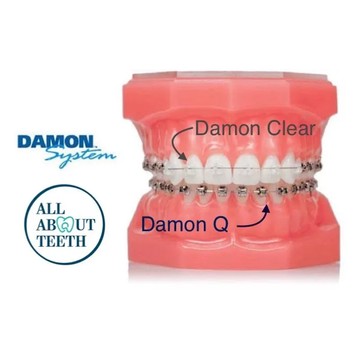 โปรโมชั่นจัดฟัน-Damon2