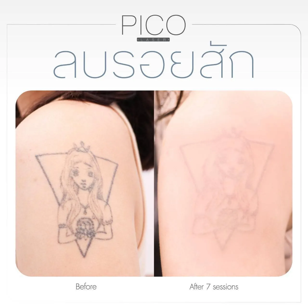 ลบรอยสัก(2)