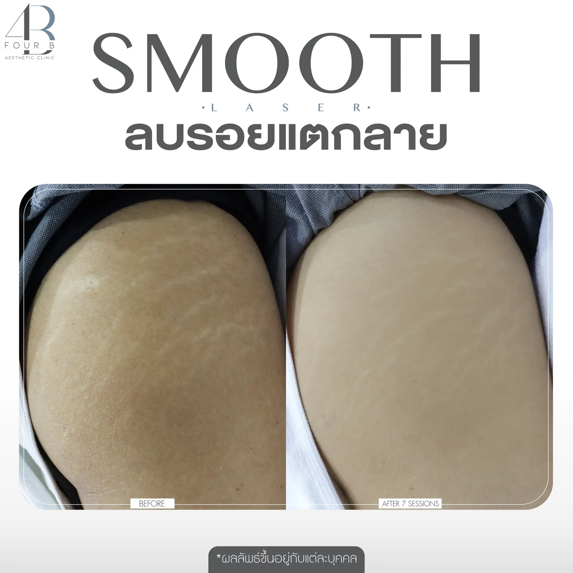 ลบรอยเเตก(8)