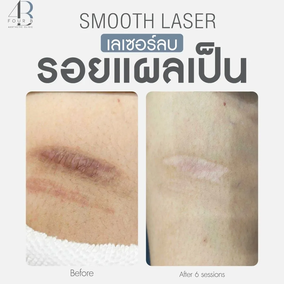 ลบแผลเป็น(2)