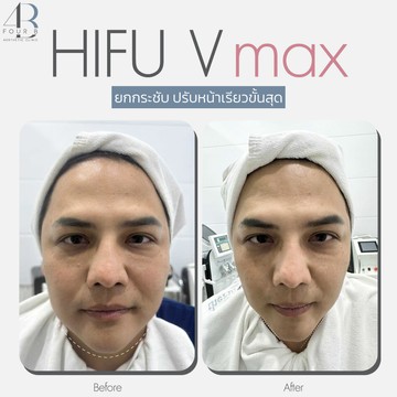 HIFU(2)