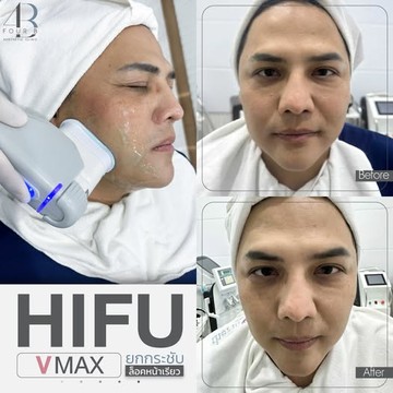 HIFU(3)