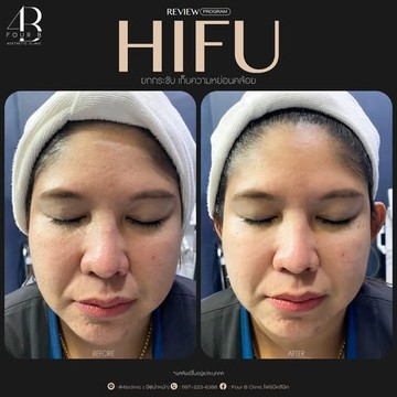 HIFU(4)
