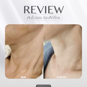 Neck-lift-(2)