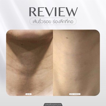 Neck-lift-(3)