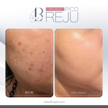 PICO(1)