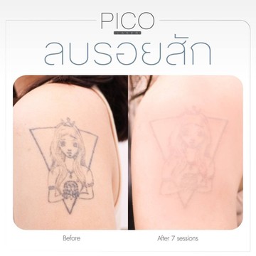 PICO(9)