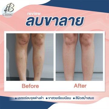 ลบรอยขาลาย(1)
