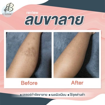 ลบรอยขาลาย(2)