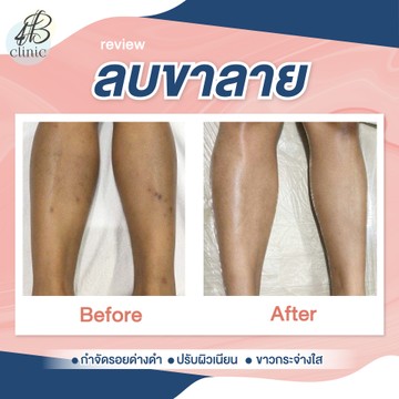 ลบรอยขาลาย(2)