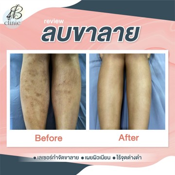 ลบรอยขาลาย(3)