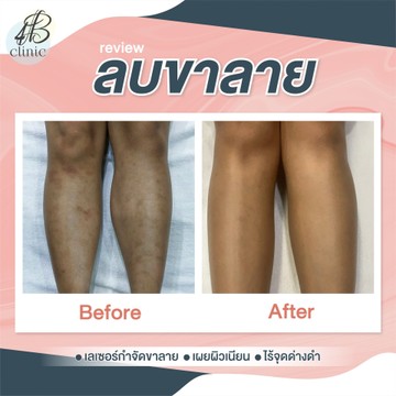ลบรอยขาลาย(4)