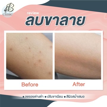 ลบรอยขาลาย(5)