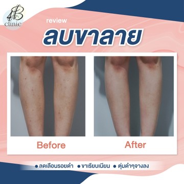 ลบรอยขาลาย(6)
