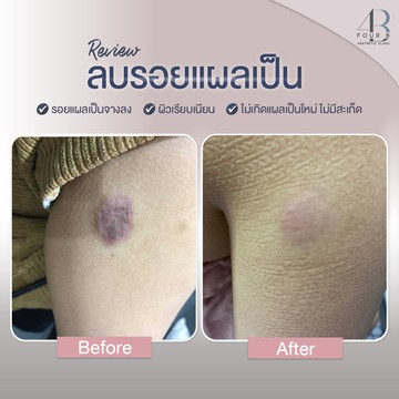 แผลเป็น(14)