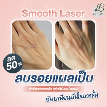 แผลเป็น(9)