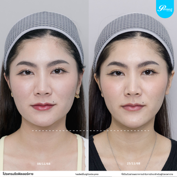 patrawutclinic-คาง01