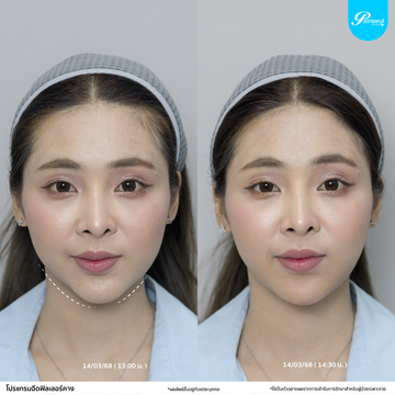 patrawutclinic-คาง03