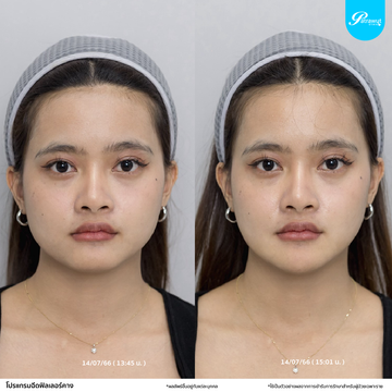 patrawutclinic-คาง05