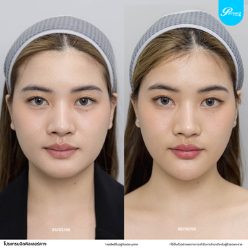 patrawutclinic-คาง06