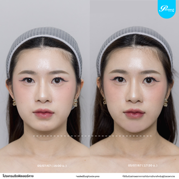 patrawutclinic-คาง