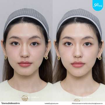patrawutclinic-คางบุ๋ม
