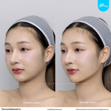 patrawutclinic-คางสั้น