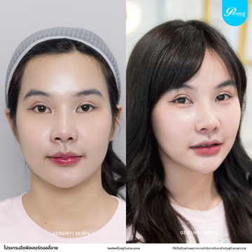 patrawutclinic-ดอลลี่อาย1