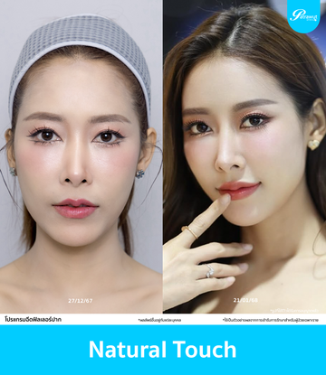patrawutclinic-ตัวอย่างฟิลเลอร์ปาก-01