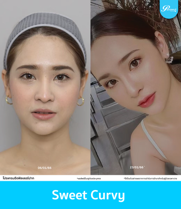 patrawutclinic-ตัวอย่างฟิลเลอร์ปาก-02