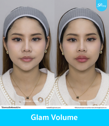 patrawutclinic-ตัวอย่างฟิลเลอร์ปาก-03