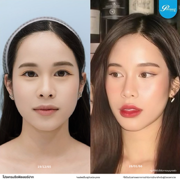 patrawutclinic-ปาก01