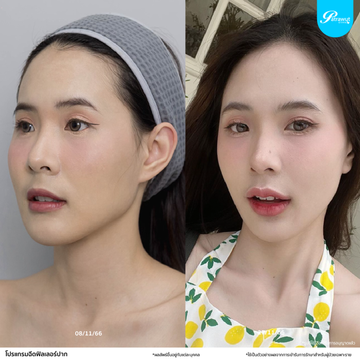 patrawutclinic-ปาก02