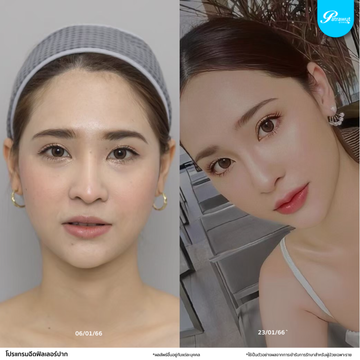 patrawutclinic-ปาก04