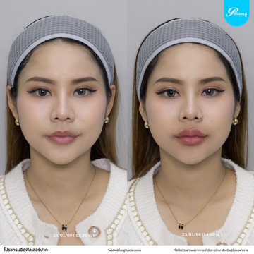 patrawutclinic-ปากสายฝอ