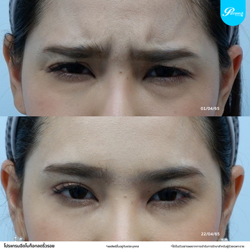patrawutclinic-ริ้วรอย001