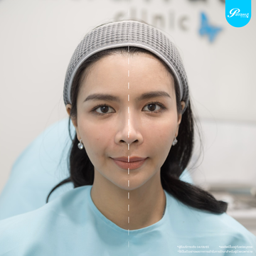 patrawutclinic-ร่องแก้ม02