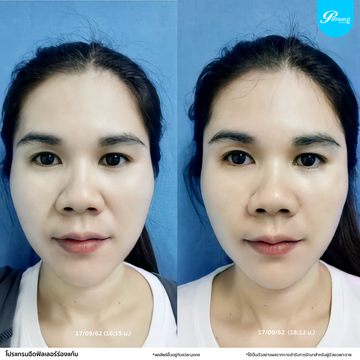patrawutclinic-ร่องแก้ม2