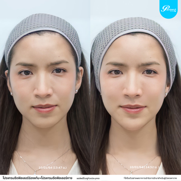 patrawutclinic-ร่องแก้ม3