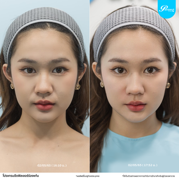 patrawutclinic-ร่องแก้ม