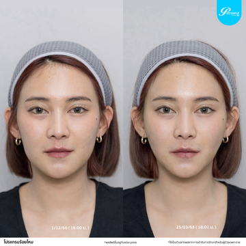patrawutclinic-ร้อยไหม01